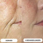 Natural Botulin 8-Wochen-Microinfusion-System™