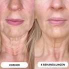 Natural Botulin 8-Wochen-Microinfusion-System™