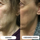 Natural Botulin 8-Wochen-Microinfusion-System™