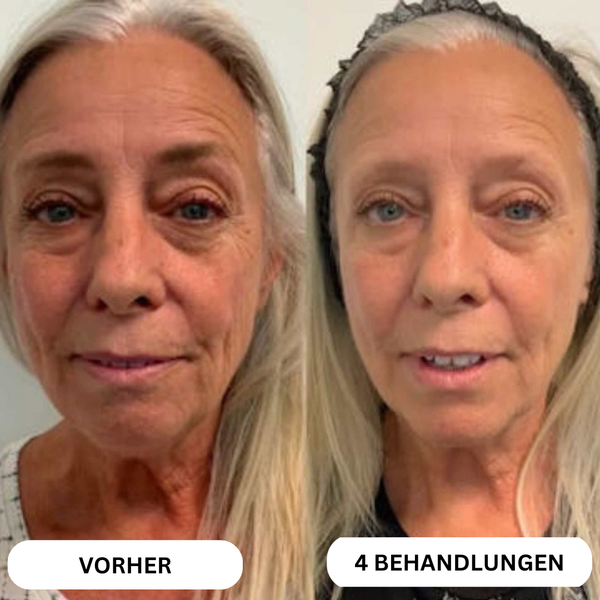 Natural Botulin 8-Wochen-Microinfusion-System™