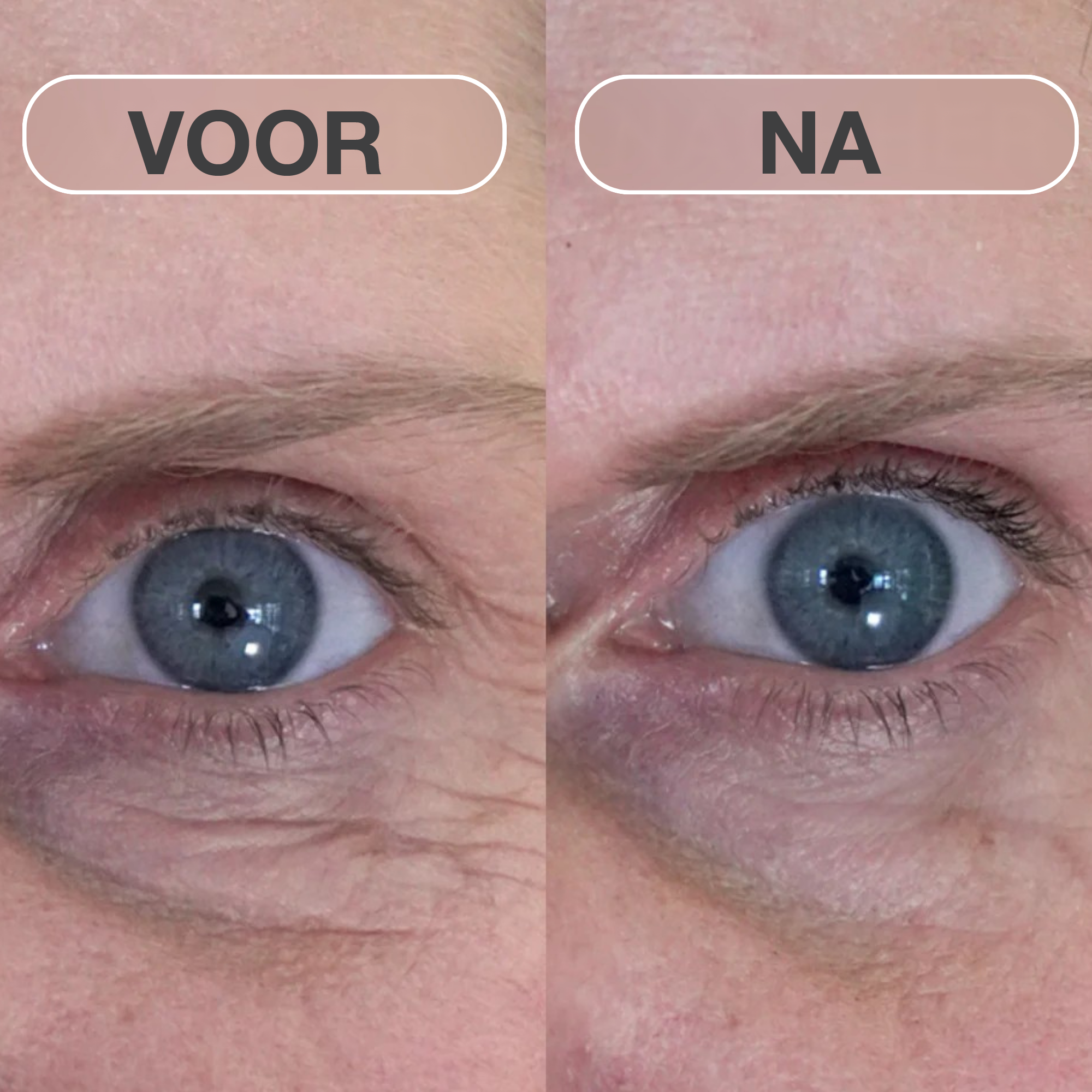 Natural Botulin microneedling-pleisters