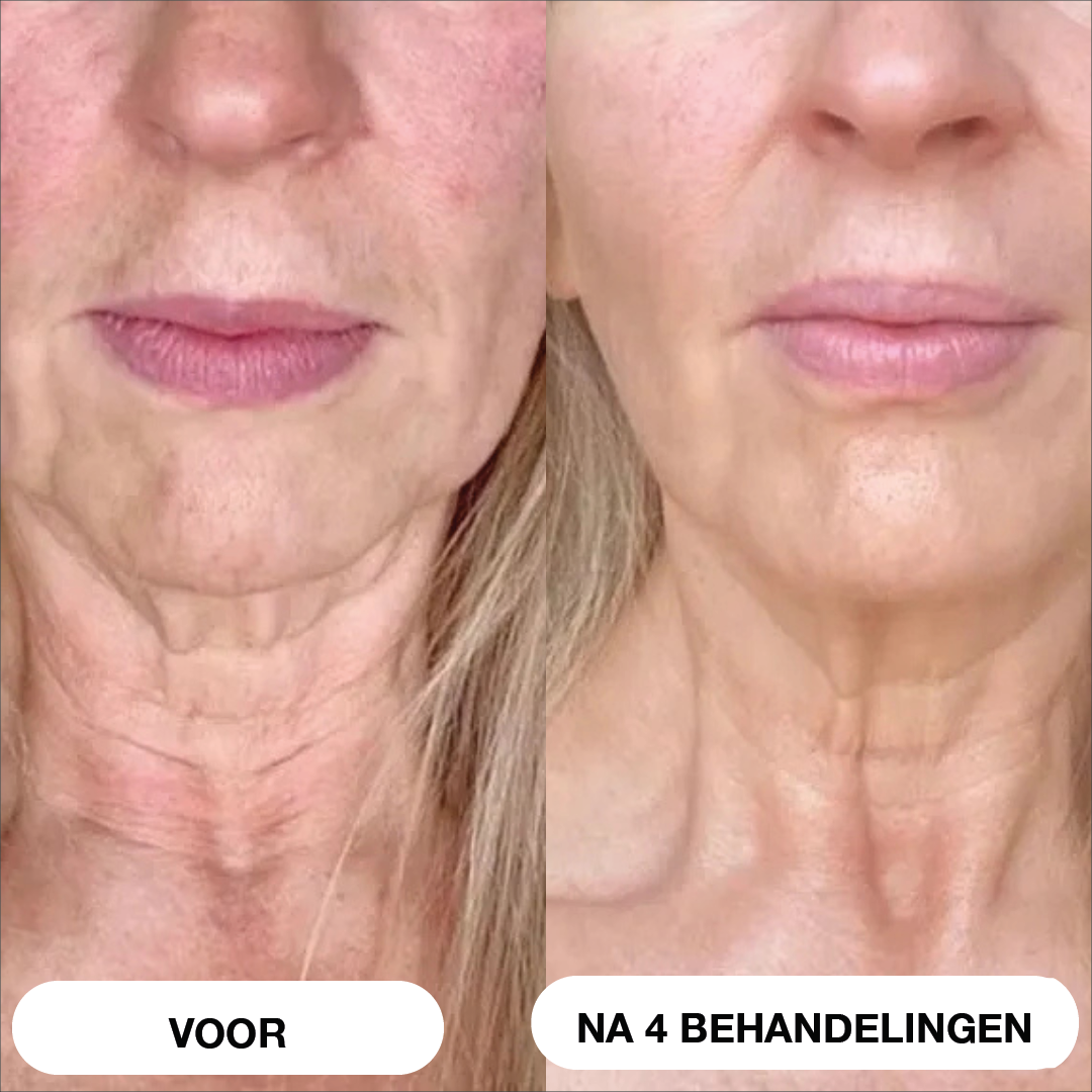 Natural Botulin 8-weken-micro-infusiesysteem™