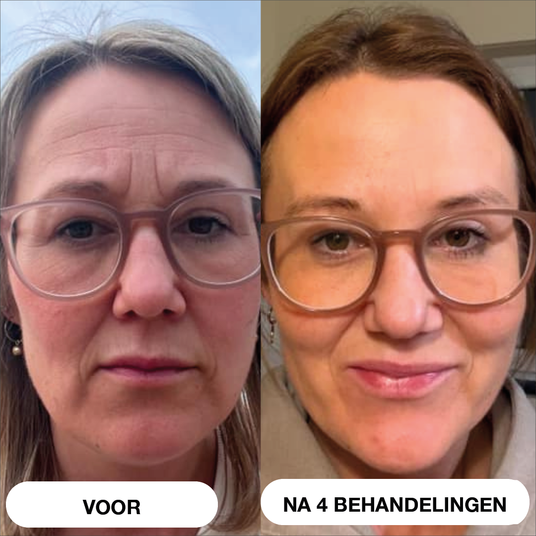 Natural Botulin 8-weken-micro-infusiesysteem™